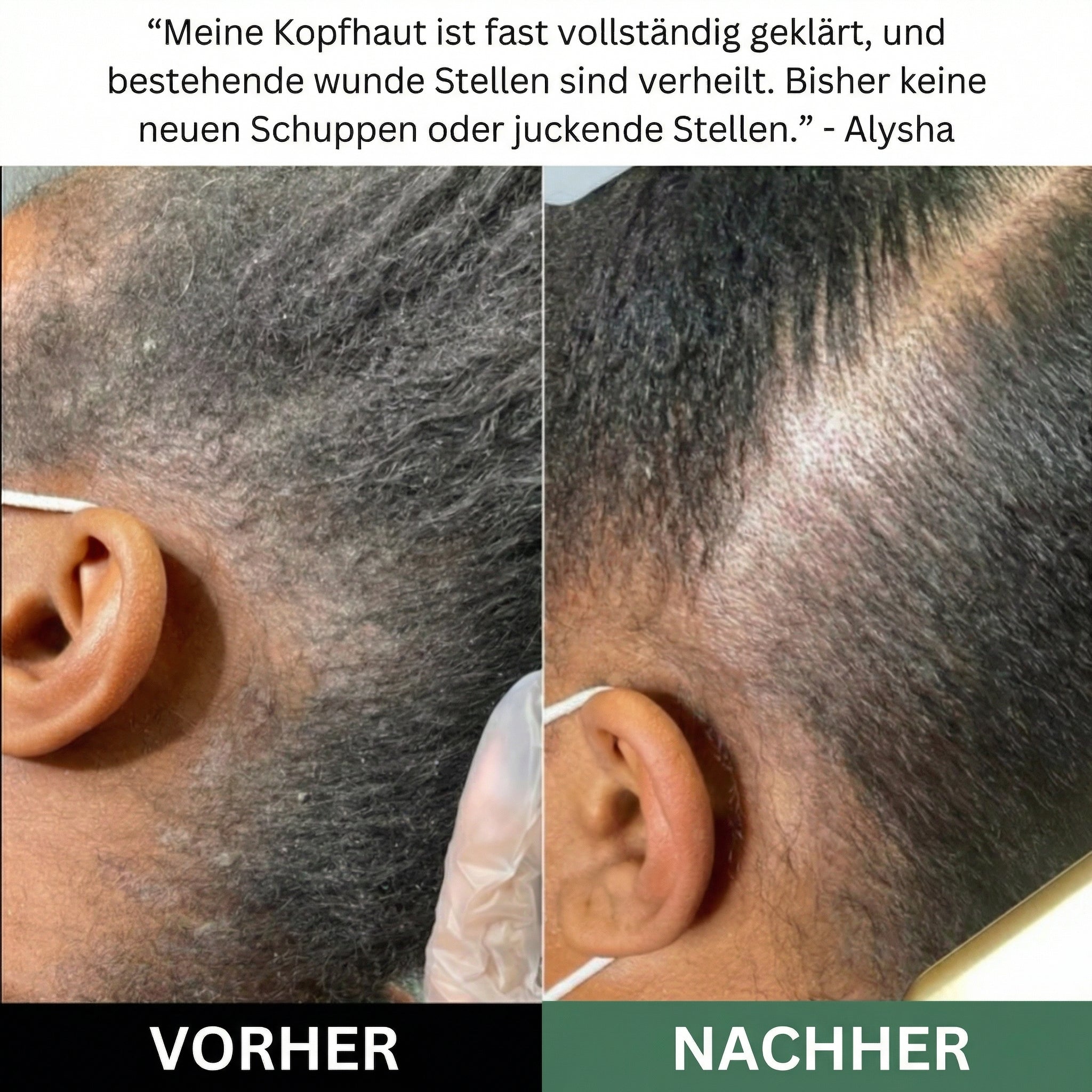 LISSIMA Natürliches Kopfhautpeeling – bei schuppiger, juckender und gereizter Kopfhaut