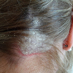 Scalp affected by psoriasis