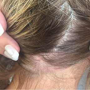 Scalp after using Lissima