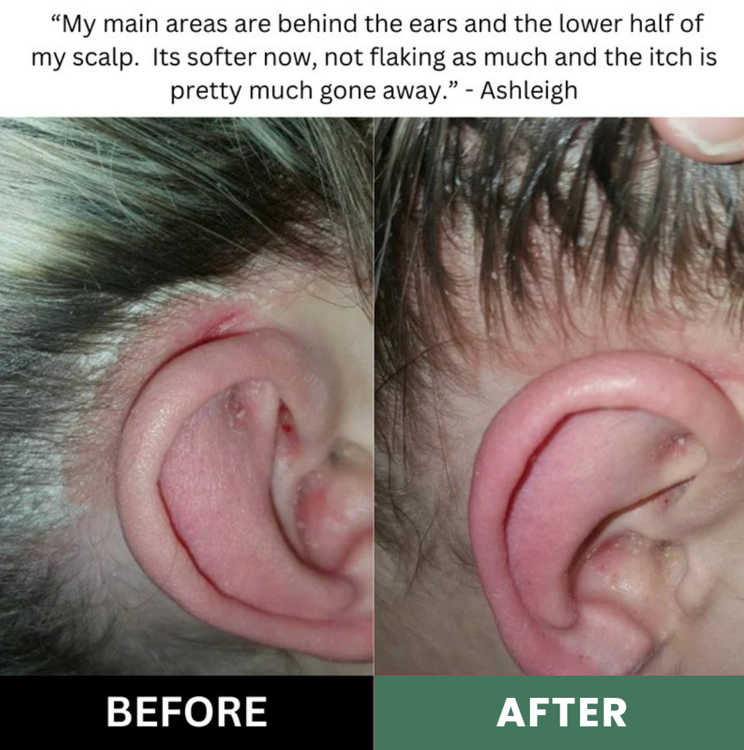 LISSIMA Natürliches Kopfhautpeeling – bei schuppiger, juckender und gereizter Kopfhaut