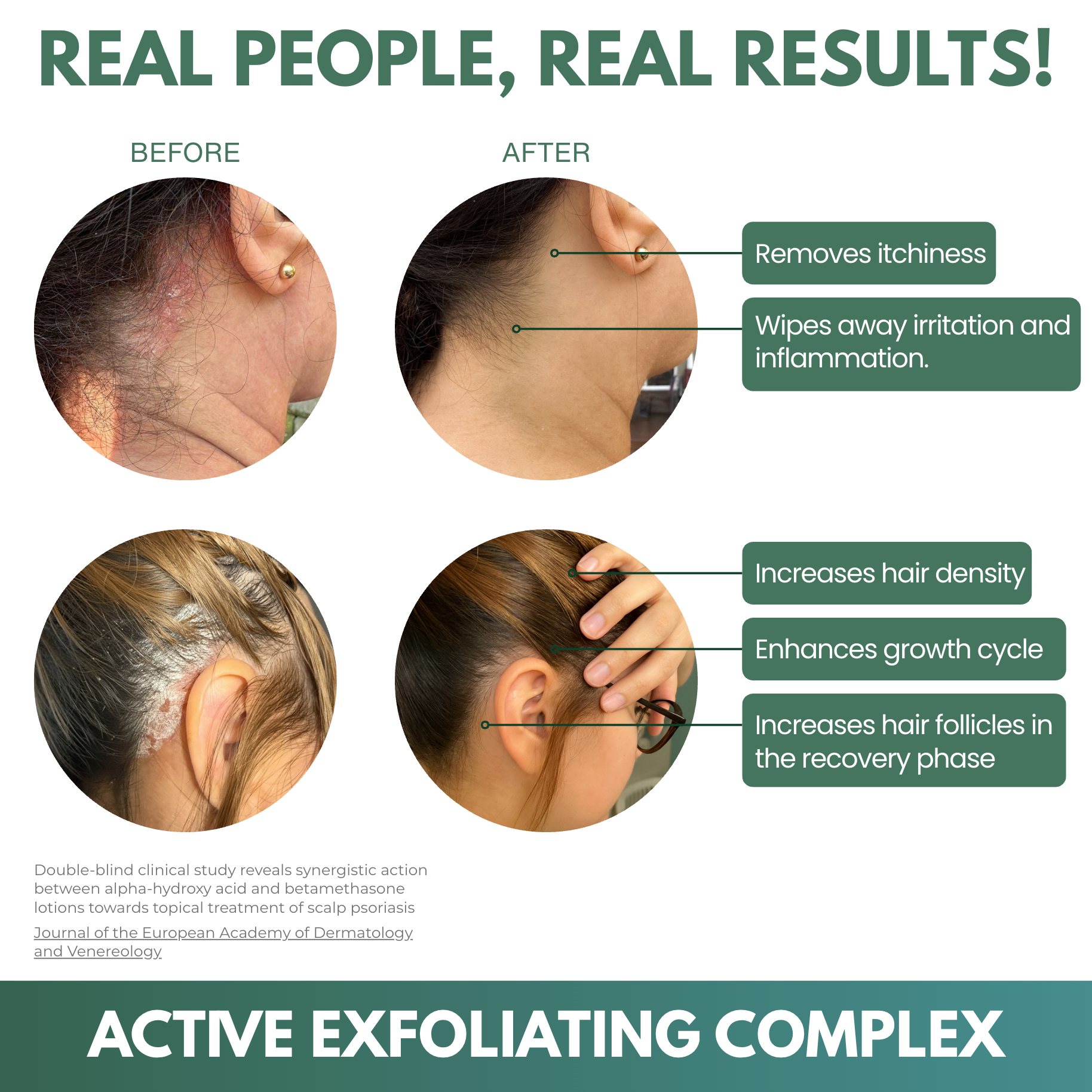 LISSIMA Natürliches Kopfhautpeeling – bei schuppiger, juckender und gereizter Kopfhaut