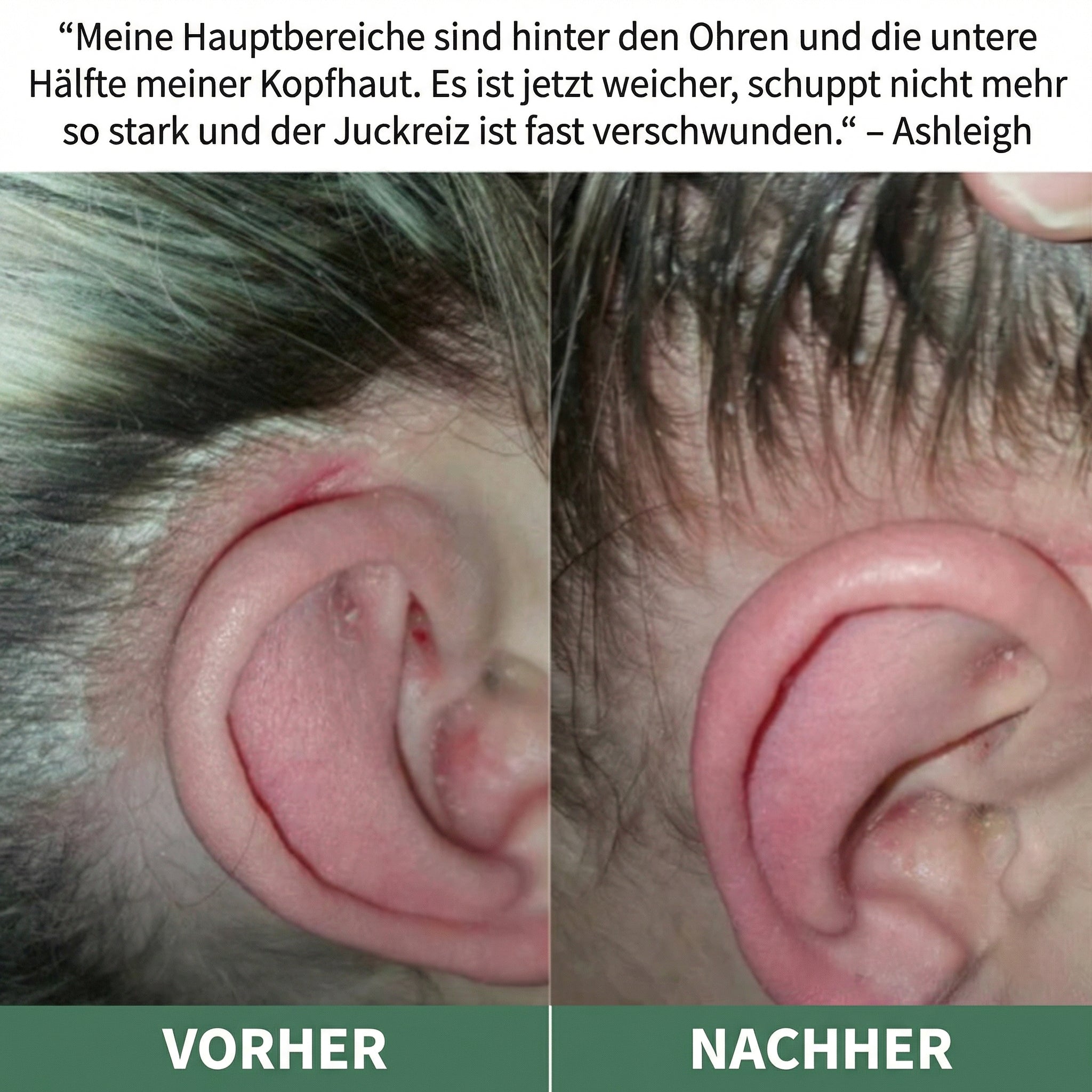 LISSIMA Natürliches Kopfhautpeeling – bei schuppiger, juckender und gereizter Kopfhaut